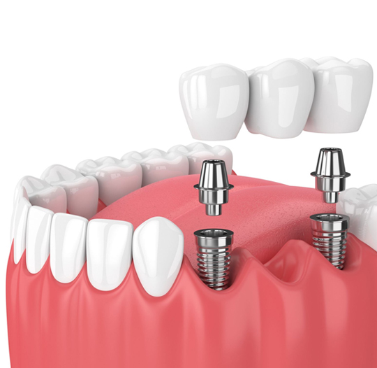 What are dental implants?